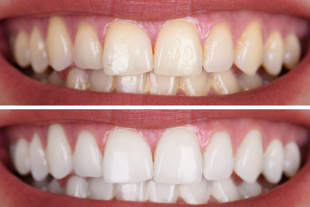 image showing yellow teeth compared to white teeth