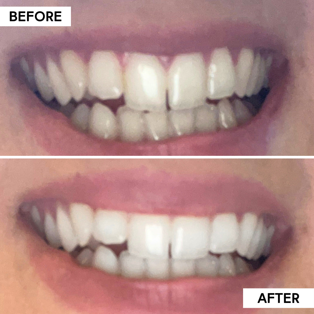 Teeth Whitening Starter Bundle Toothpaste + Whitening Strips – Icy Bear