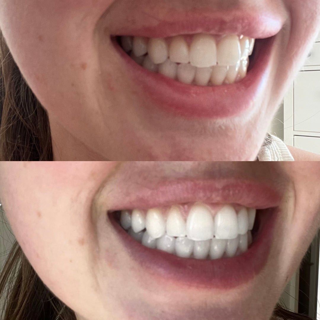 Pearly Teeth Whitening Bundle - Icy Bear Dental