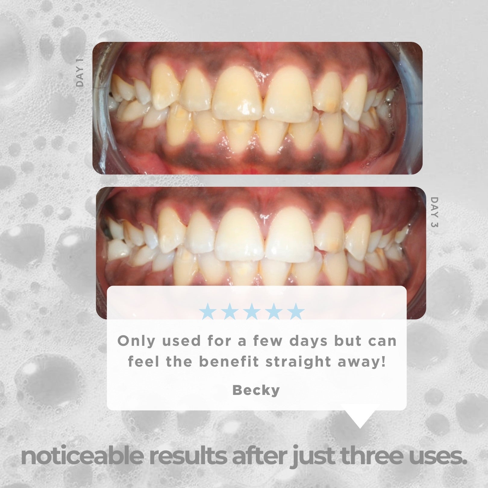 IcyBear★ Teeth Whitening Kit – Icy Bear Dental